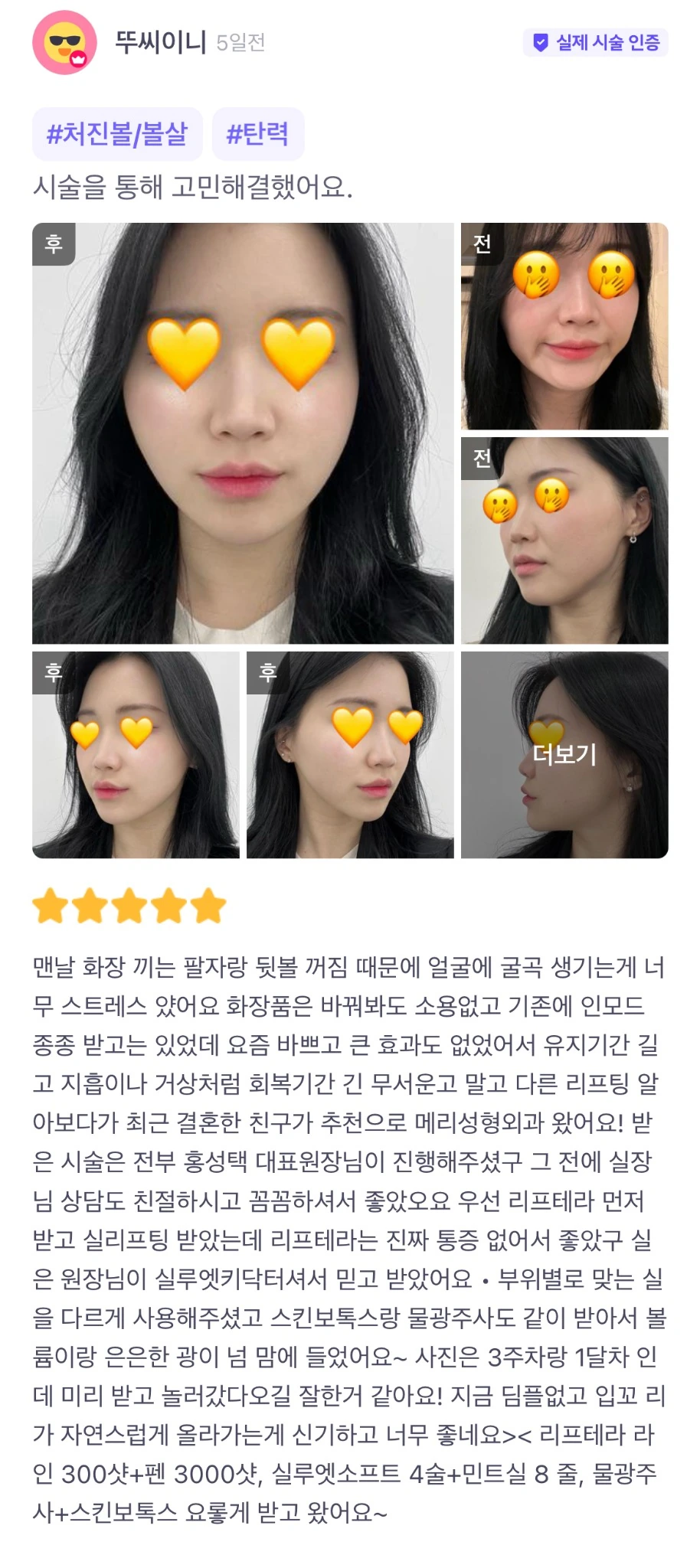 Liftera ultrasound lifting, thread lifting and skin botulinum toxin patient photo review — 208 at Merry Plastic Surgery Clinic. Liftera ultrasound lifting, thread lifting and skin botulinum toxin at Merry Plastic Surgery: before-and-after photographs shown in the supplied patient review.