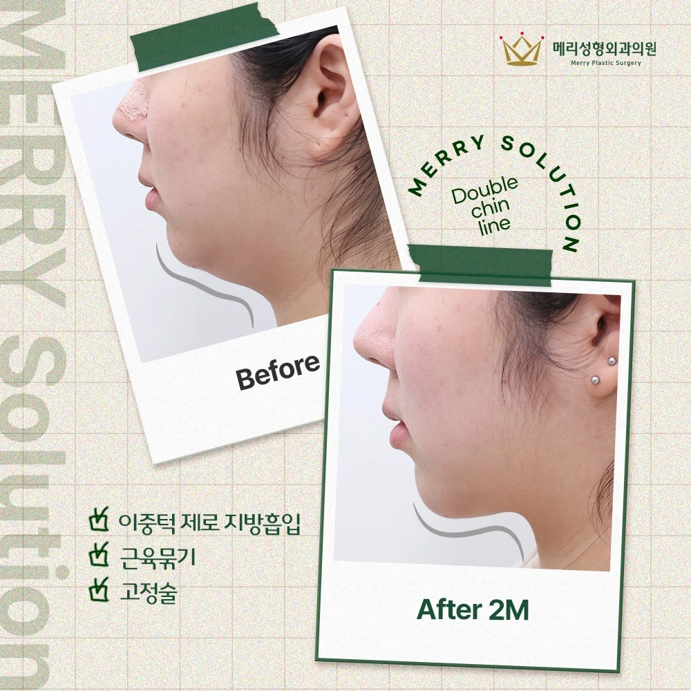 Double-chin liposuction with muscle tightening and fixation before and after — 368 at Merry Plastic Surgery Clinic. Double-chin liposuction with muscle tightening and fixation at Merry Plastic Surgery: before-and-after photographs shown in the supplied clinic comparison. The source labels the follow-up as 2 months.