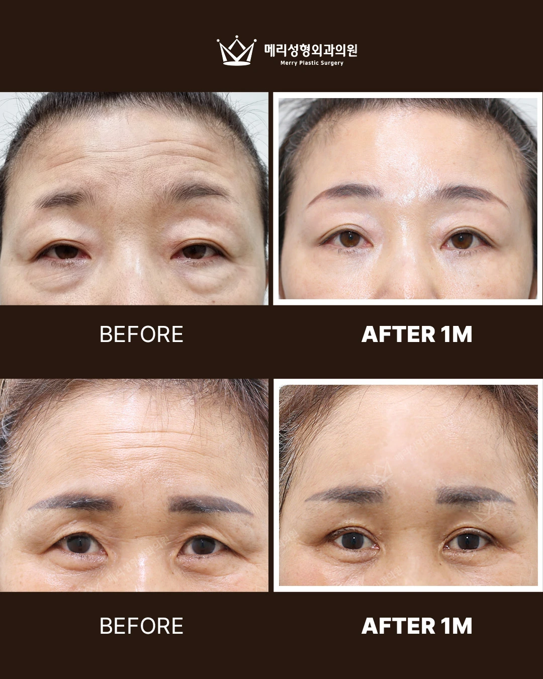 Forehead lift before and after — 406 at Merry Plastic Surgery Clinic. Two forehead-lift comparisons showing the brow and upper-eyelid area; both pairs are labelled 1 month after surgery. Do not assume the pairs are one patient.