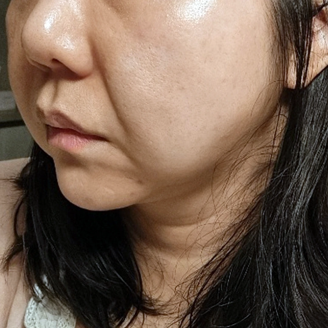 Facelift — angled comparison 1 at MODS Clinic. Before treatment. Angled views of the lower cheek, fold beside the mouth and jawline.