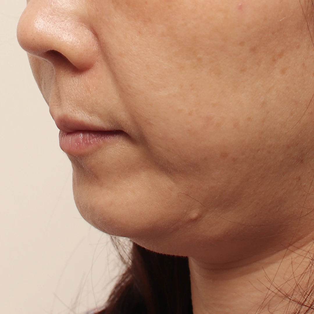 Facelift — angled comparison 2 at MODS Clinic. Before treatment. Close-up views of the cheek, mouth and chin, showing the lower facial outline.