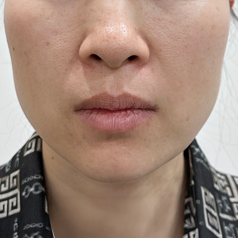 Facial lifting — front view at MODS Clinic. MODS Clinic: Facial lifting — front view. Before photograph; follow-up interval not supplied.
