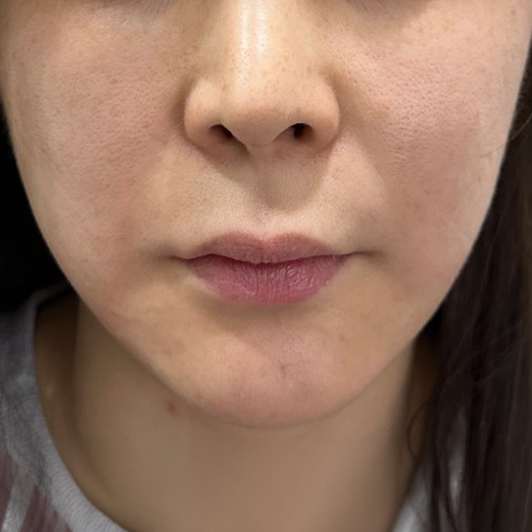 Facial lifting — lower-face comparison at MODS Clinic. MODS Clinic: Facial lifting — lower-face comparison. After photograph; follow-up interval not supplied.