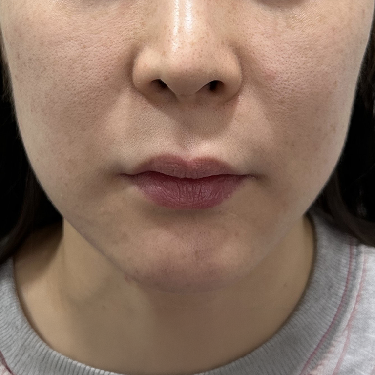 Facial lifting — lower-face comparison at MODS Clinic. MODS Clinic: Facial lifting — lower-face comparison. Before photograph; follow-up interval not supplied.