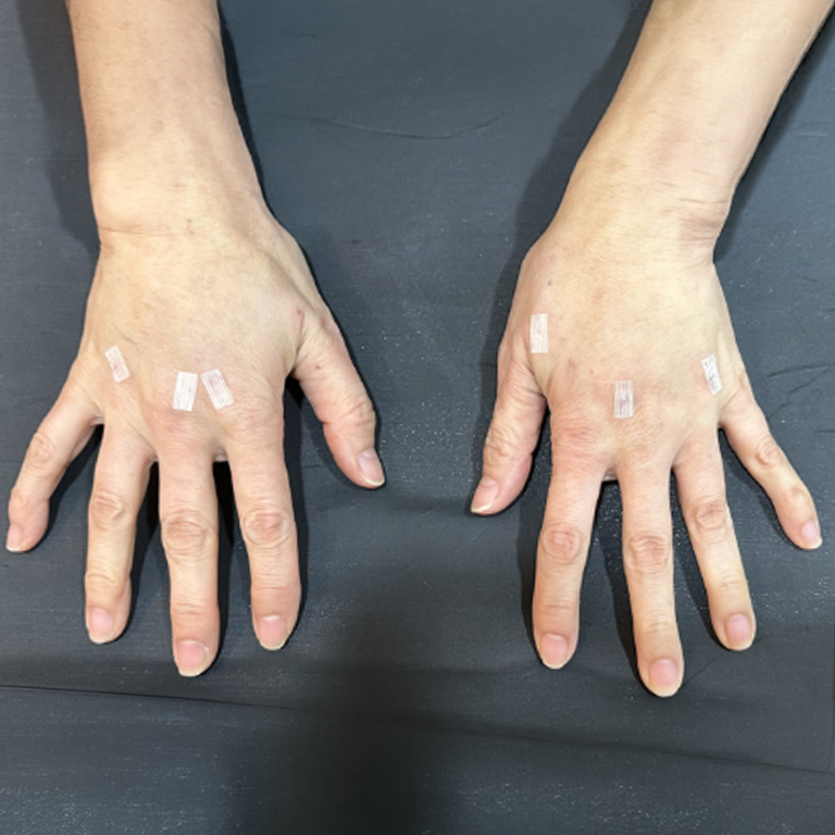Hand filler — back-of-hand views at MODS Clinic. MODS Clinic: Hand filler — back-of-hand views. After photograph; follow-up interval not supplied.