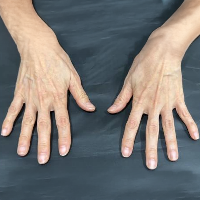 Hand filler — back-of-hand views at MODS Clinic. MODS Clinic: Hand filler — back-of-hand views. Before photograph; follow-up interval not supplied.