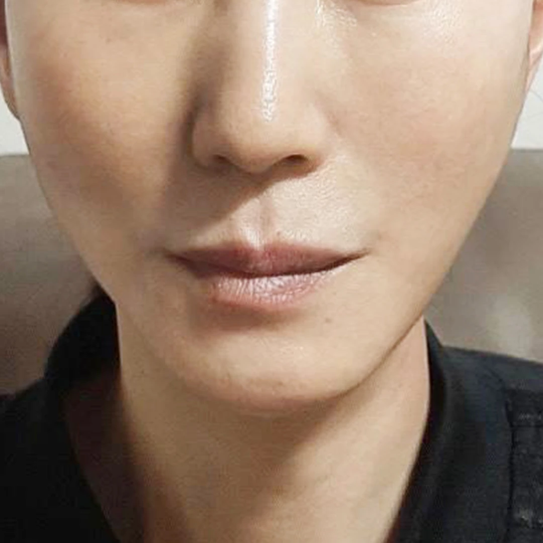 Mini facelift — front view at MODS Clinic. After treatment. Front-facing close-ups showing the folds beside the mouth, the chin and the lower cheek contours.