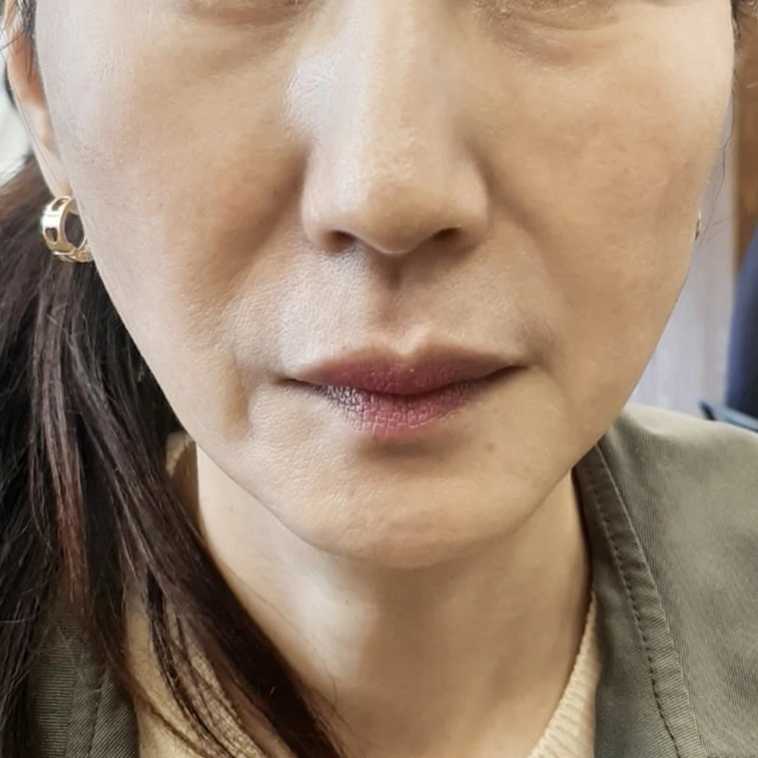 Mini facelift — front view at MODS Clinic. Before treatment. Front-facing close-ups showing the folds beside the mouth, the chin and the lower cheek contours.