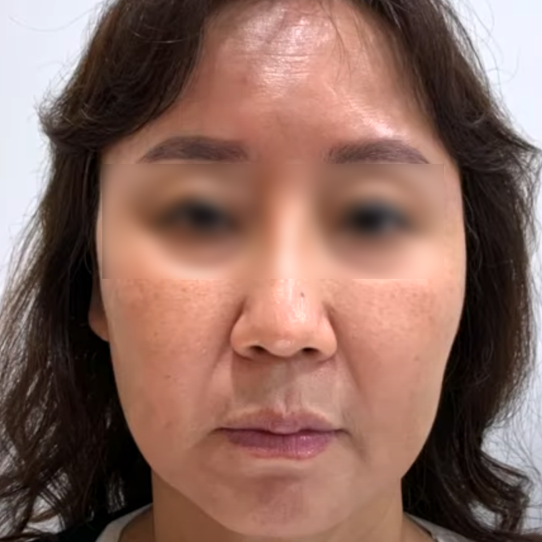 Mini facelift — front-view comparison 02 at MODS Clinic. MODS Clinic: Mini facelift — front-view comparison 02. Before photograph; follow-up interval not supplied.