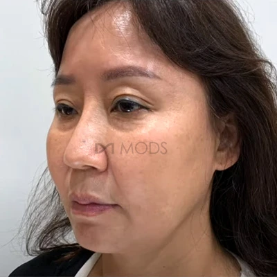 Mini facelift with under-eye fat grafting at MODS Clinic. Before treatment. Angled views showing the cheek, under-eye area and jawline together.