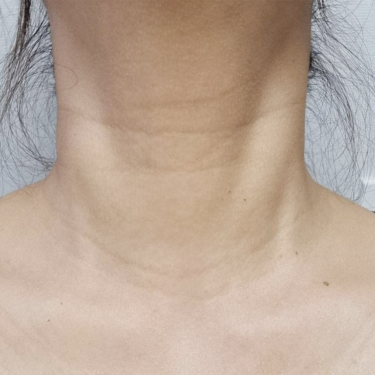 Neck lines — photo comparison at MODS Clinic. MODS Clinic: Neck lines — photo comparison. Before photograph; follow-up interval not supplied.