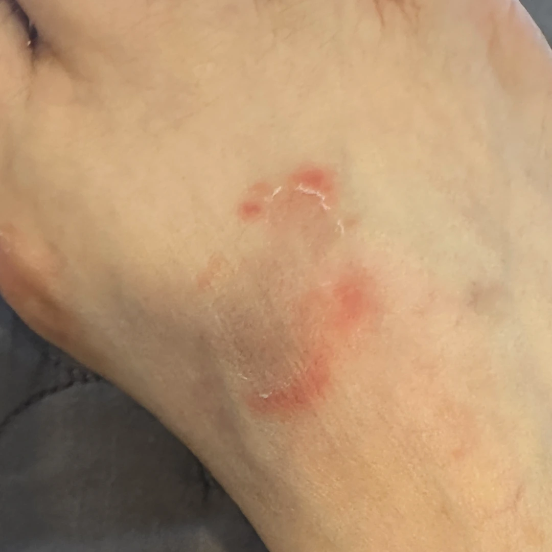 Psoriasis photo follow-up — foot and lower-leg views at MODS Clinic. 2 weeks: photograph of the top of the foot, showing the visible skin patches.