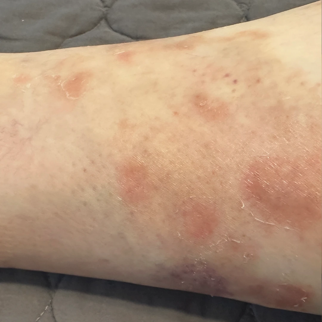 Psoriasis photo follow-up — foot and lower-leg views at MODS Clinic. 2 weeks: photograph of the lower leg, showing the visible skin patches.