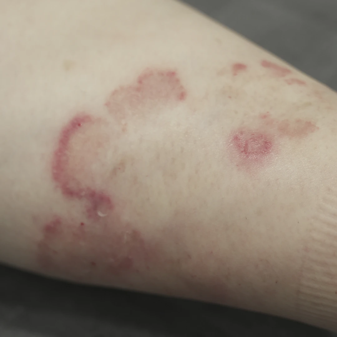 Psoriasis photo follow-up — foot and lower-leg views at MODS Clinic. 2 weeks: photograph of a close-up of another area on the leg, showing the visible skin patches.