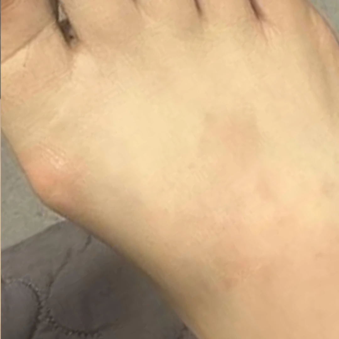 Psoriasis photo follow-up — foot and lower-leg views at MODS Clinic. 6 weeks: photograph of the top of the foot, showing the visible skin patches.
