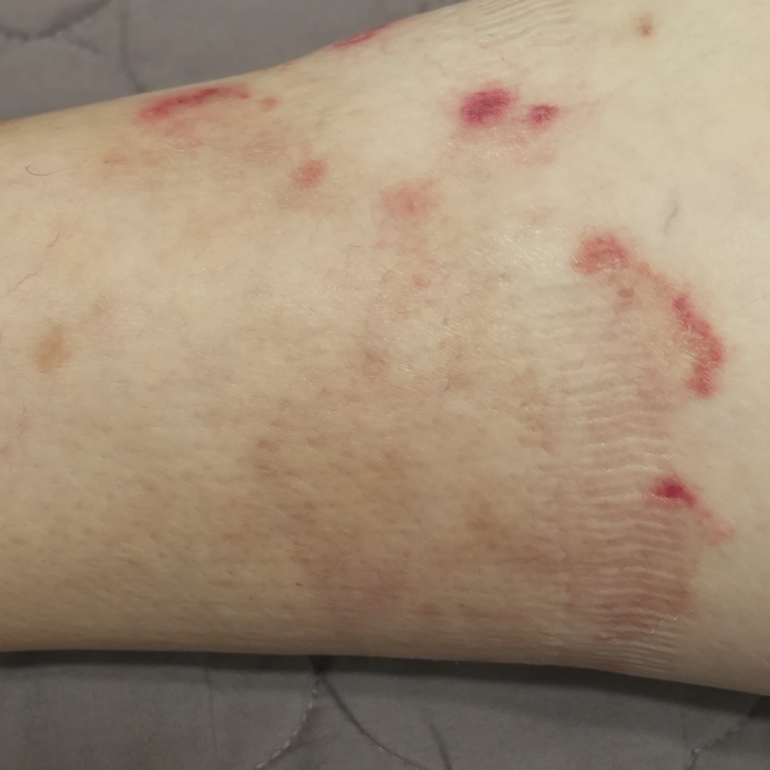 Psoriasis photo follow-up — foot and lower-leg views at MODS Clinic. 6 weeks: photograph of the lower leg, showing the visible skin patches.