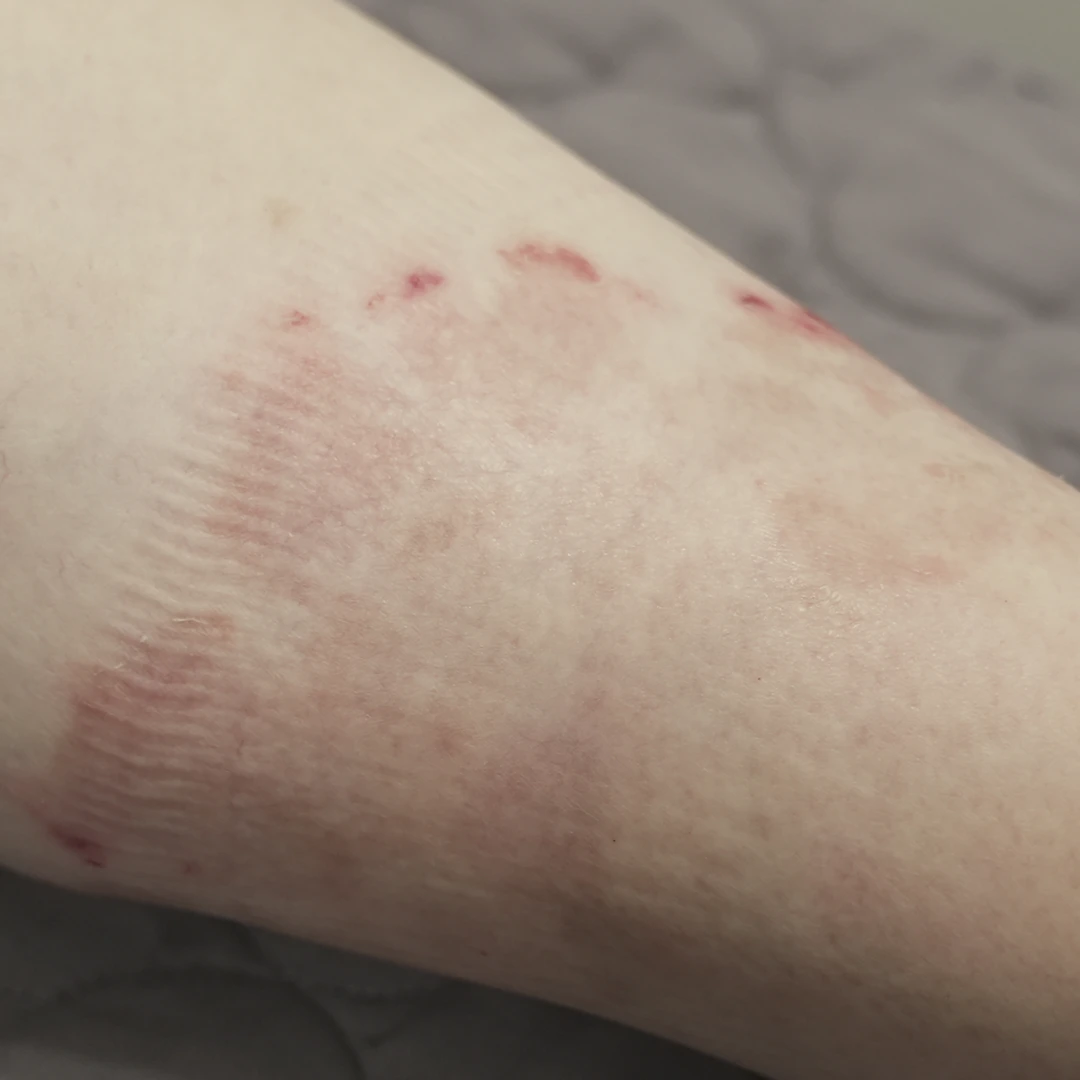 Psoriasis photo follow-up — foot and lower-leg views at MODS Clinic. 6 weeks: photograph of a close-up of another area on the leg, showing the visible skin patches.