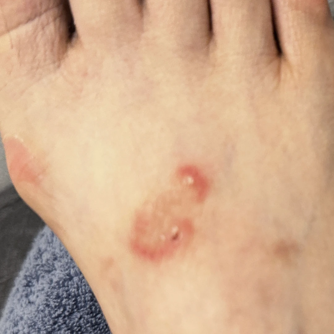 Psoriasis photo follow-up — foot and lower-leg views at MODS Clinic. Before: photograph of the top of the foot, showing the visible skin patches.