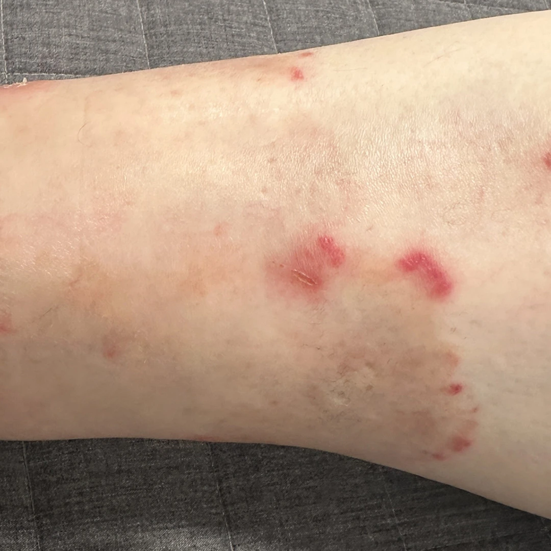 Psoriasis photo follow-up — foot and lower-leg views at MODS Clinic. Before: photograph of the lower leg, showing the visible skin patches.