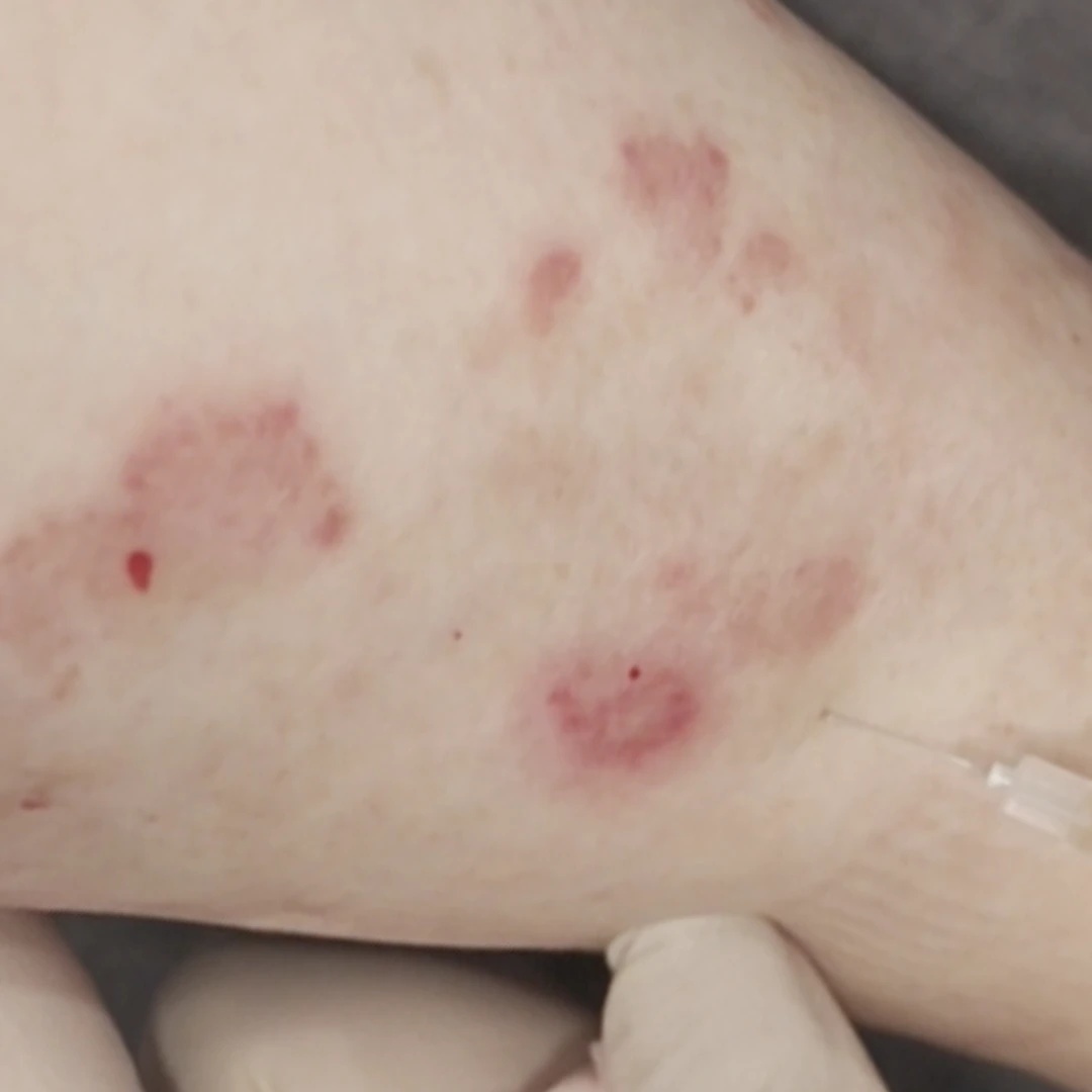 Psoriasis photo follow-up — foot and lower-leg views at MODS Clinic. Before: photograph of a close-up of another area on the leg, showing the visible skin patches.