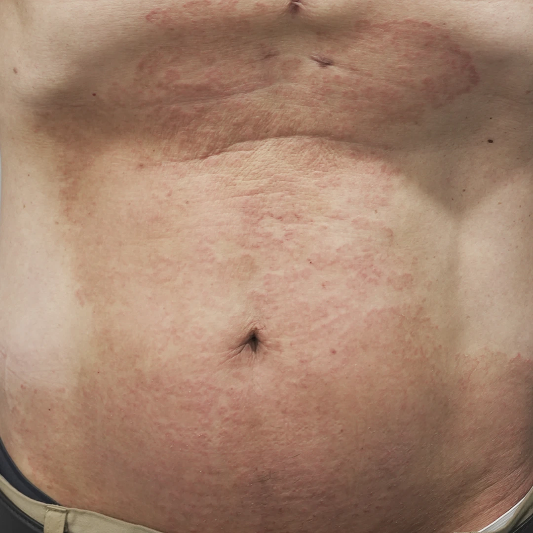 Psoriasis photo follow-up — abdominal views at MODS Clinic. Before: photograph of the abdomen, showing the visible skin patches.