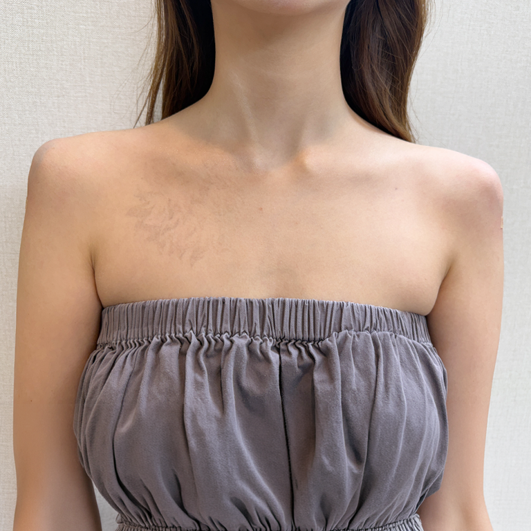 Shoulder filler — front view at MODS Clinic. MODS Clinic: Shoulder filler — front view. After photograph; follow-up interval not supplied.