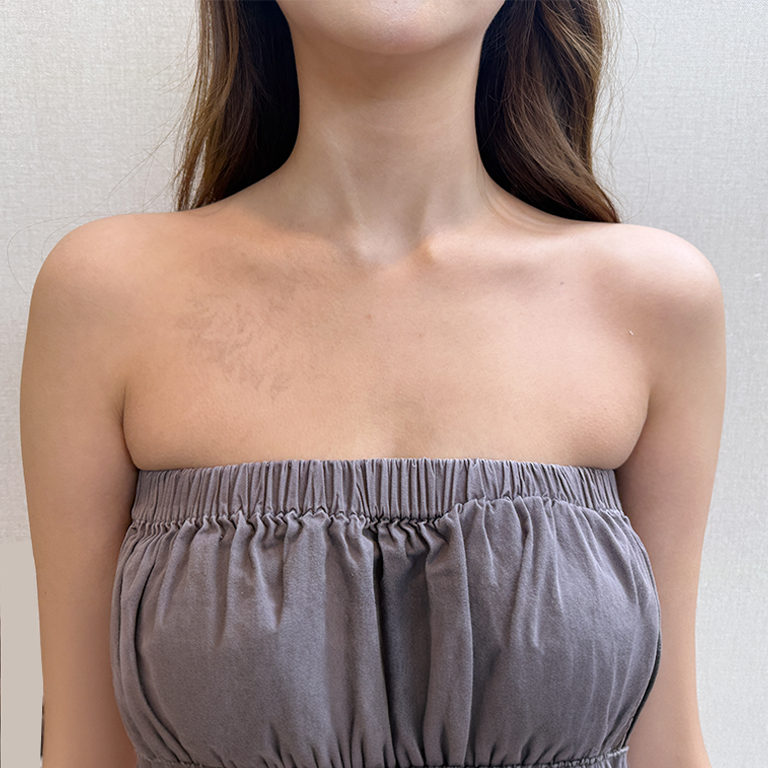 Shoulder filler — front view at MODS Clinic. MODS Clinic: Shoulder filler — front view. Before photograph; follow-up interval not supplied.