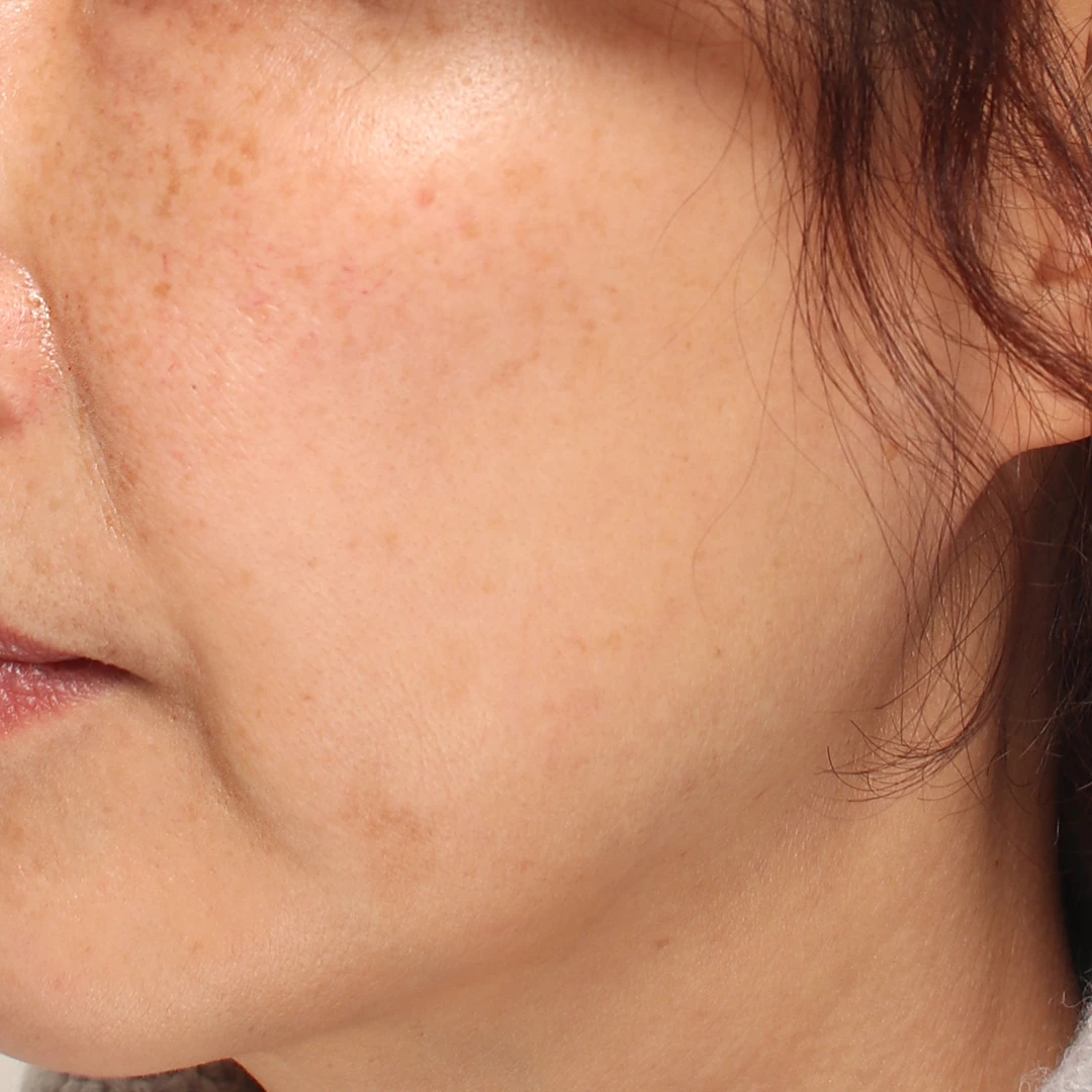 Thread lift — angled view at MODS Clinic. Before treatment. Angled close-ups of the cheek and lower facial outline.