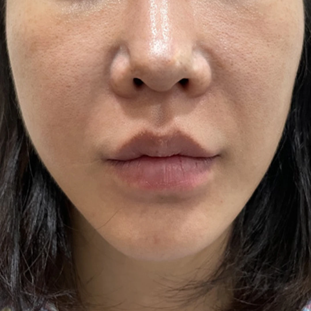 Ultherapy with thread lifting at MODS Clinic. Before treatment. Front-facing photographs showing the lower cheeks, folds beside the mouth and chin.