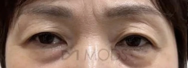 Under-eye fat repositioning with sub-brow lift at MODS Clinic. Before treatment. A close-up of both eyes, including the skin below the brows and the contours beneath the lower lids.