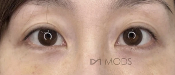 Under-eye fat repositioning — comparison 1 at MODS Clinic. After treatment. Front-facing eye photographs showing the lower eyelids and the transition into the upper cheeks.
