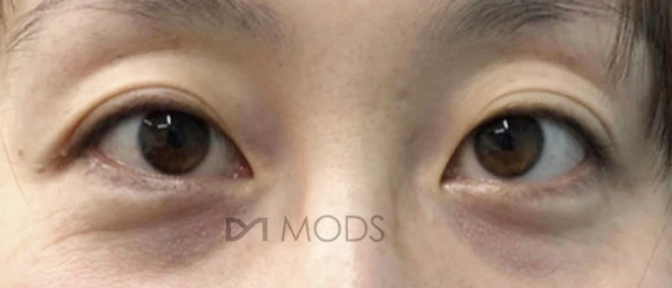 Under-eye fat repositioning — comparison 1 at MODS Clinic. Before treatment. Front-facing eye photographs showing the lower eyelids and the transition into the upper cheeks.