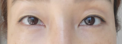 Under-eye fat repositioning — comparison 2 at MODS Clinic. After treatment. A close-up of both lower eyelids.