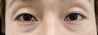 Under-eye fat repositioning — comparison 2 at MODS Clinic. Before treatment. A close-up of both lower eyelids.