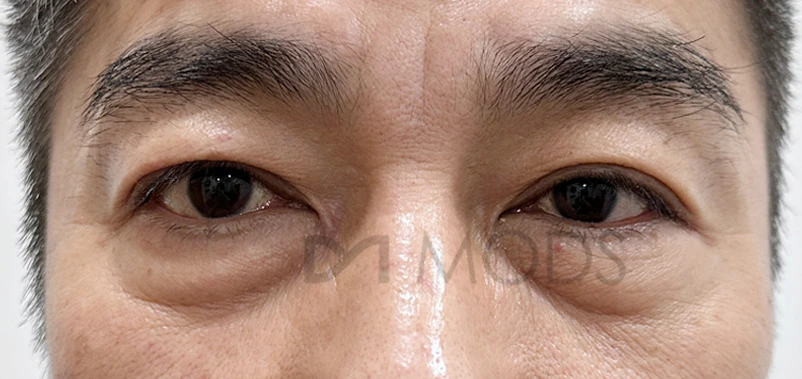 Under-eye fat repositioning — comparison 3 at MODS Clinic. Before treatment. Front-facing photographs showing the lower eyelid folds and contours beneath both eyes.