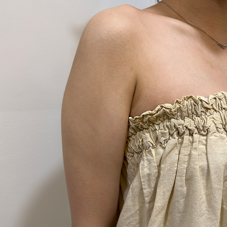 Upper-arm fat-dissolving treatment at MODS Clinic. MODS Clinic: Upper-arm fat-dissolving treatment. Before photograph; follow-up interval not supplied.
