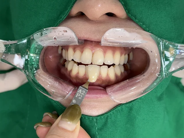Osstem Vussen teeth whitening at New York S Dental Clinic. New York S Dental Clinic — Osstem Vussen teeth whitening, clinical view 1 of 2.