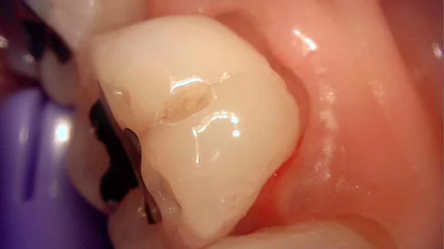 Cervical abrasion: resin restoration near the gumline at New York S Dental Clinic. New York S Dental Clinic — Cervical abrasion: resin restoration near the gumline, clinical view 1 of 4.