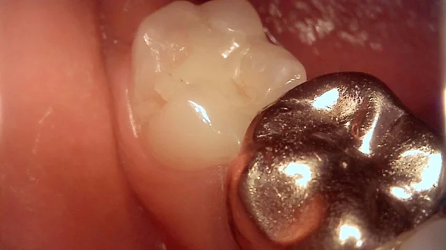 Resin restoration: three stages of a back tooth at New York S Dental Clinic. New York S Dental Clinic — Resin restoration: three stages of a back tooth, clinical view 1 of 3.