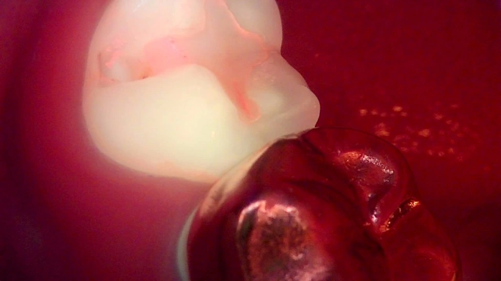 Resin restoration: three stages of a back tooth at New York S Dental Clinic. New York S Dental Clinic — Resin restoration: three stages of a back tooth, clinical view 2 of 3.