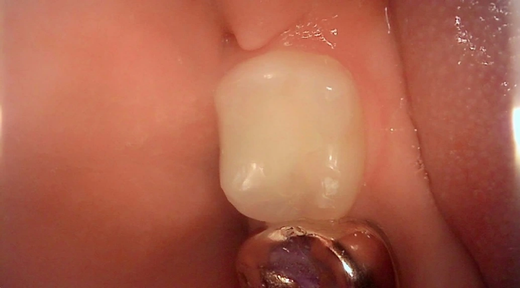 Resin restoration: three stages of a back tooth at New York S Dental Clinic. New York S Dental Clinic — Resin restoration: three stages of a back tooth, clinical view 3 of 3.