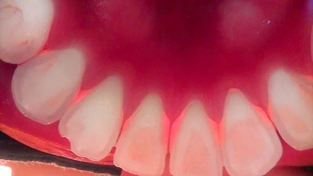 Dental scaling: lower front teeth at New York S Dental Clinic. New York S Dental Clinic — Dental scaling: lower front teeth, clinical view 1 of 2.