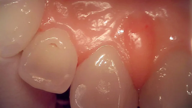 Tooth 22 resin restoration: three clinical views at New York S Dental Clinic. New York S Dental Clinic — Tooth 22 resin restoration: three clinical views, clinical view 1 of 3.