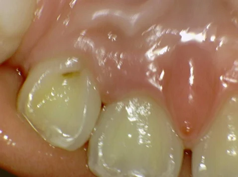 Tooth 22 resin restoration: inner-surface comparison at New York S Dental Clinic. New York S Dental Clinic — Tooth 22 resin restoration: inner-surface comparison, clinical view 1 of 2.