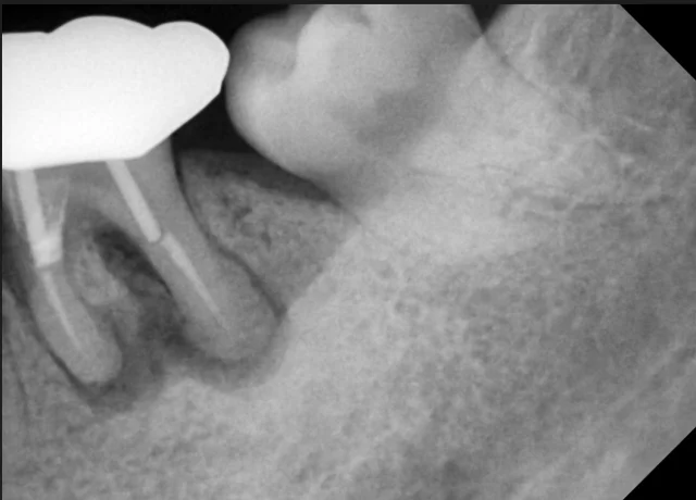 Root-fractured tooth: surgical extraction X-rays at New York S Dental Clinic. New York S Dental Clinic — Root-fractured tooth: surgical extraction X-rays, clinical view 1 of 2.