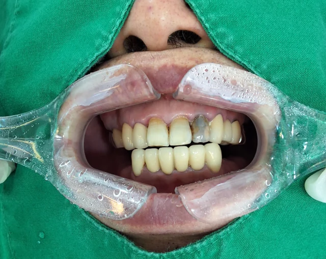 Tooth 22 zirconia crown: smile sequence at New York S Dental Clinic. New York S Dental Clinic — Tooth 22 zirconia crown: smile sequence, clinical view 1 of 3.