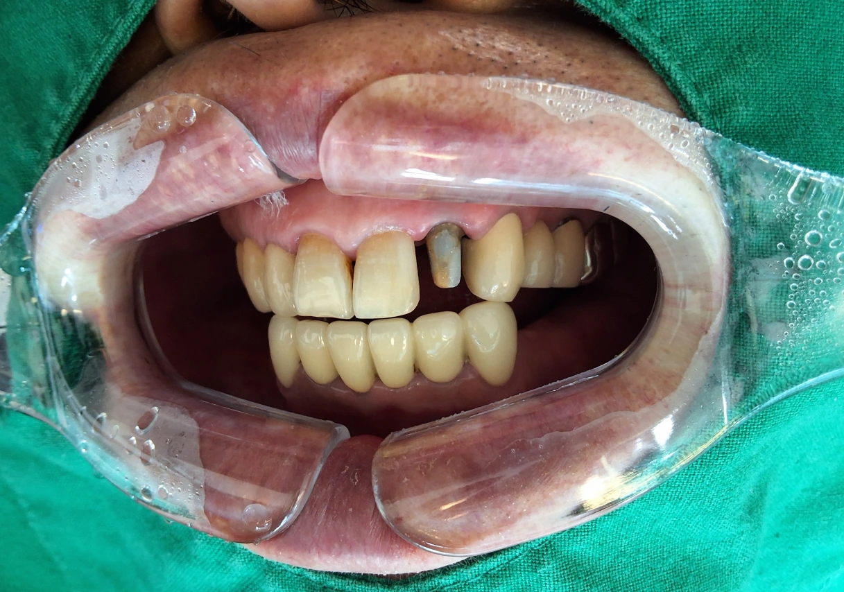 Tooth 22 zirconia crown: smile sequence at New York S Dental Clinic. New York S Dental Clinic — Tooth 22 zirconia crown: smile sequence, clinical view 2 of 3.