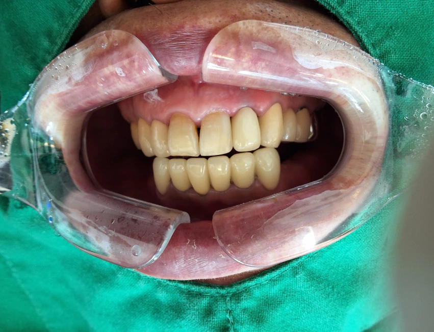 Tooth 22 zirconia crown: smile sequence at New York S Dental Clinic. New York S Dental Clinic — Tooth 22 zirconia crown: smile sequence, clinical view 3 of 3.