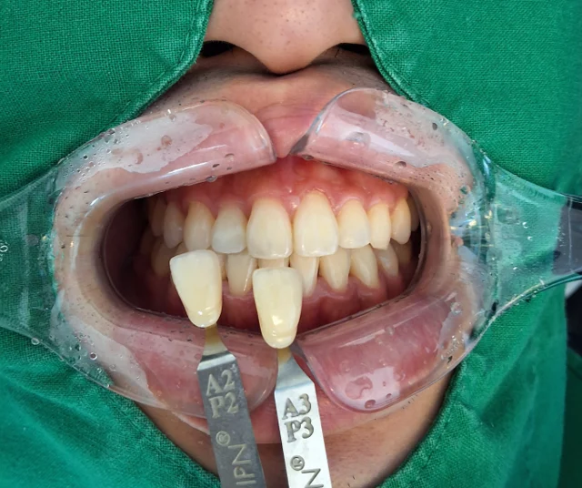 Professional whitening: front-tooth shade comparison at New York S Dental Clinic. New York S Dental Clinic — Professional whitening: front-tooth shade comparison, clinical view 1 of 2.