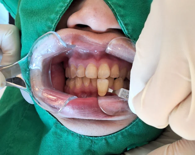 Professional whitening: two front-tooth close-ups at New York S Dental Clinic. New York S Dental Clinic — Professional whitening: two front-tooth close-ups, clinical view 1 of 2.